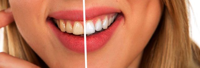 Teeth whiten.