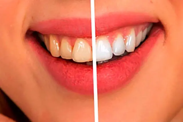 Whiten Teeth and Eyeballs.